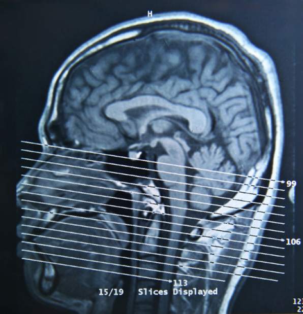 366031Concussionbrain