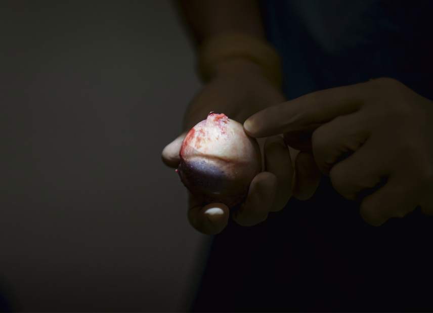 PTRhipreplacement0771216 PTRhipreplacement0771216